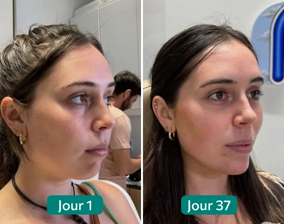 Résultat Nuclever Sophie — Avant Jour 1 / Après Jour 37